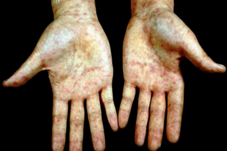 手掌三期梅毒疹图