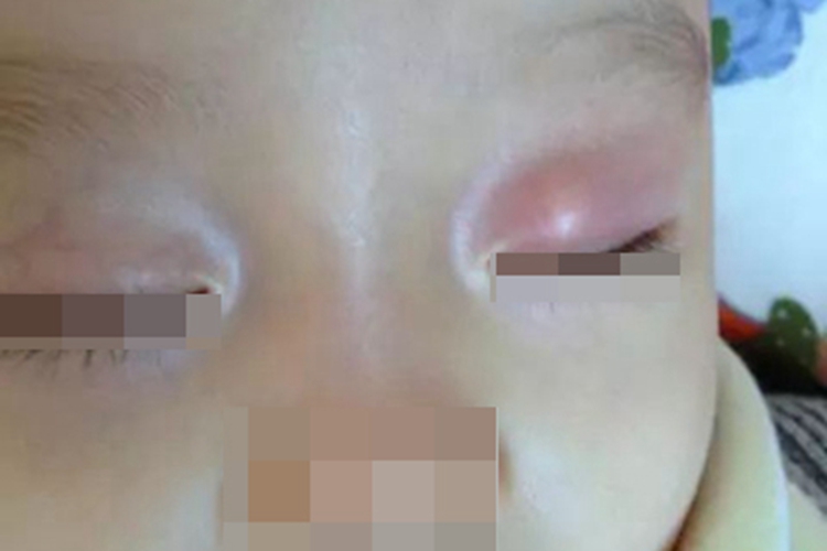 新生儿水肿红肿图