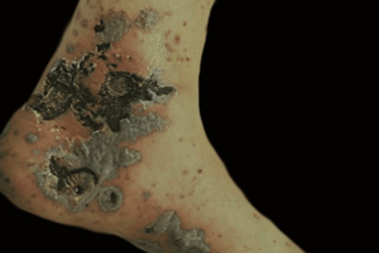 儿童结节性多动脉炎脚部结痂图 儿童结节性多动脉炎脚部结痂图