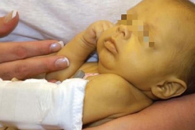 急性新生儿核黄疸症状图 急性新生儿核黄疸症状图