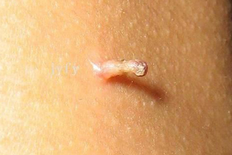 脖子处丝线状丝状疣图