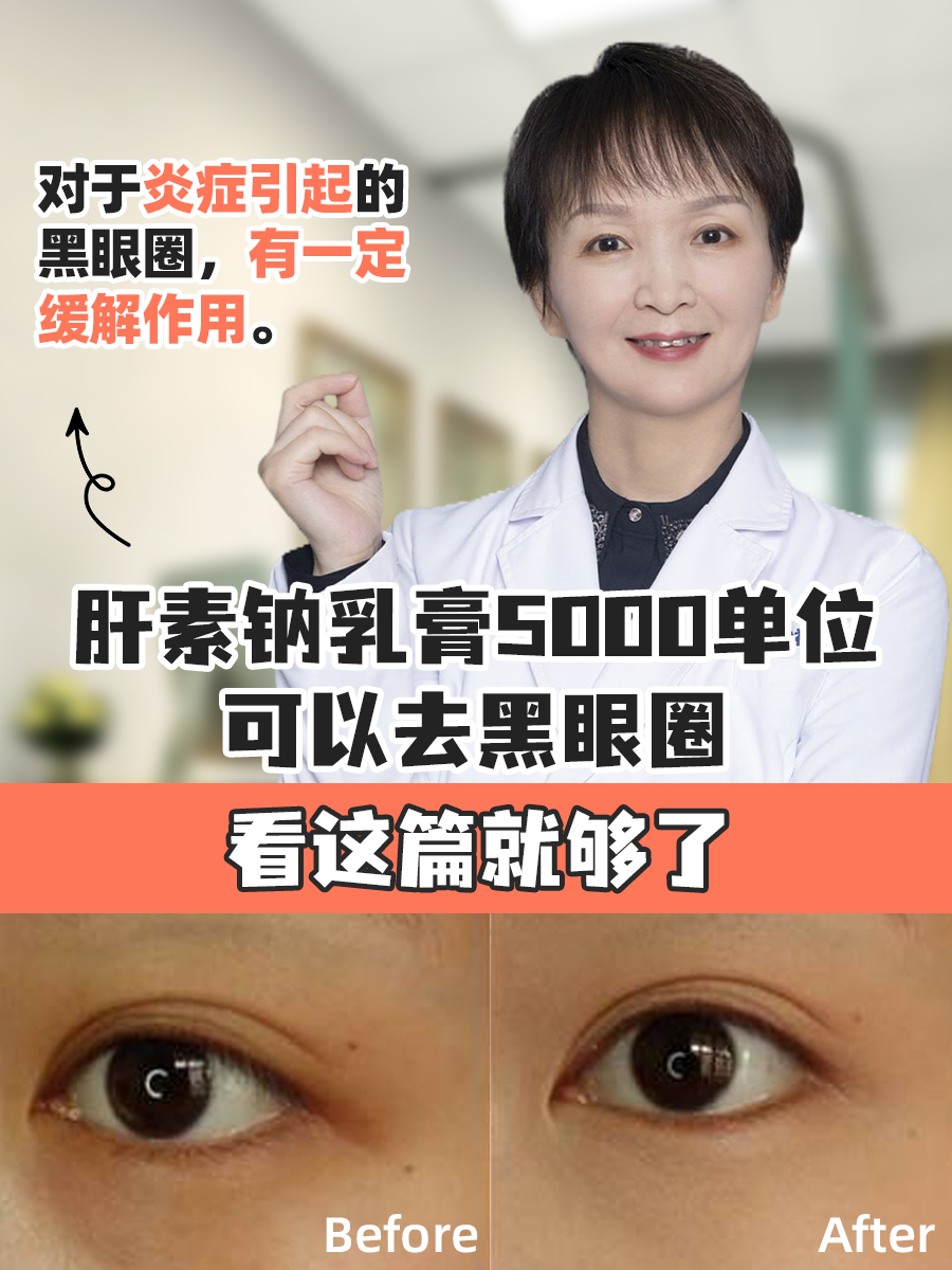 肝素钠乳膏5000单位可以去黑眼圈，看这篇就够了