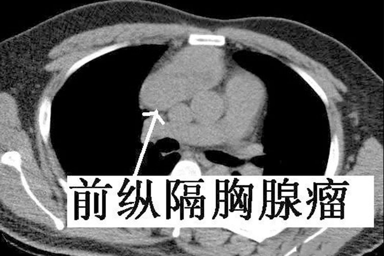 前纵隔胸腺瘤影像部位图