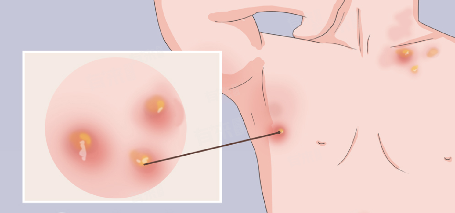 疖子怎么催熟-有来医生