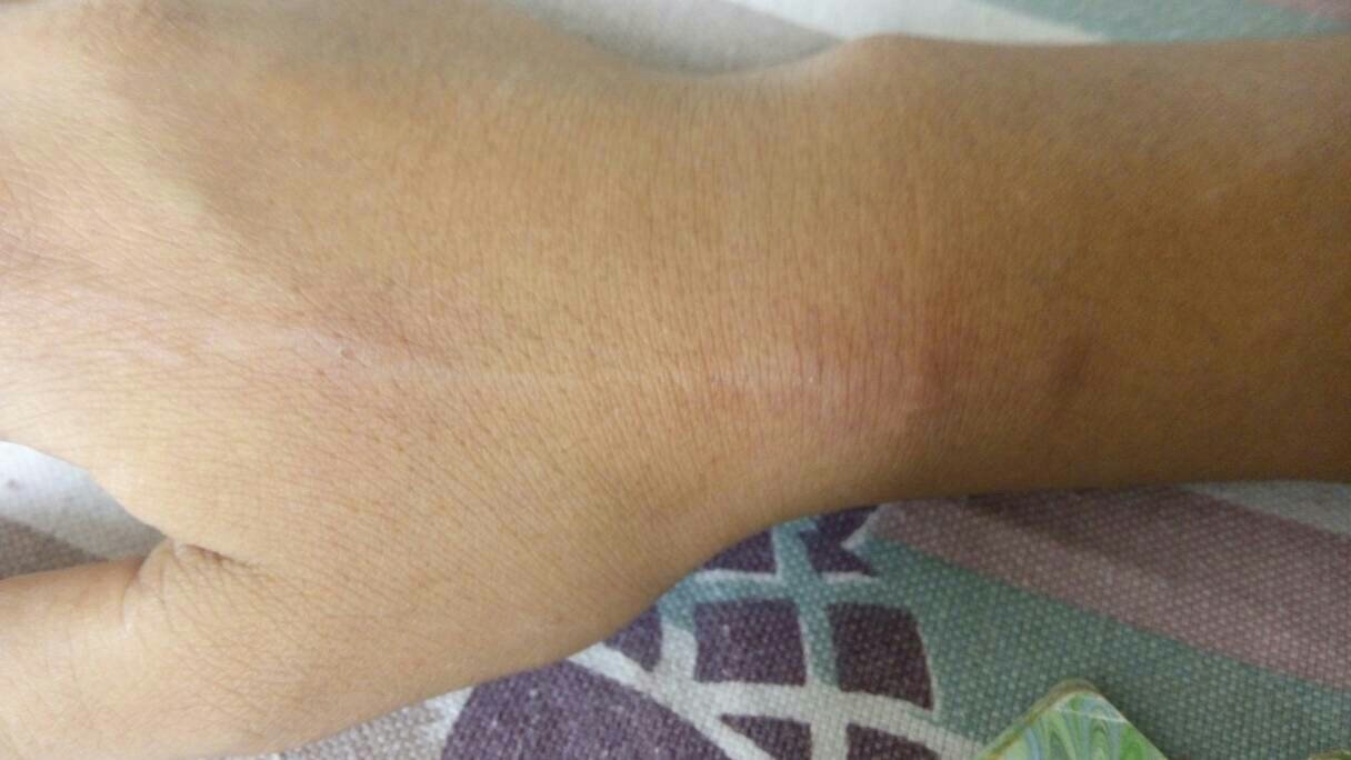 狂犬病暴露Ⅱ级图