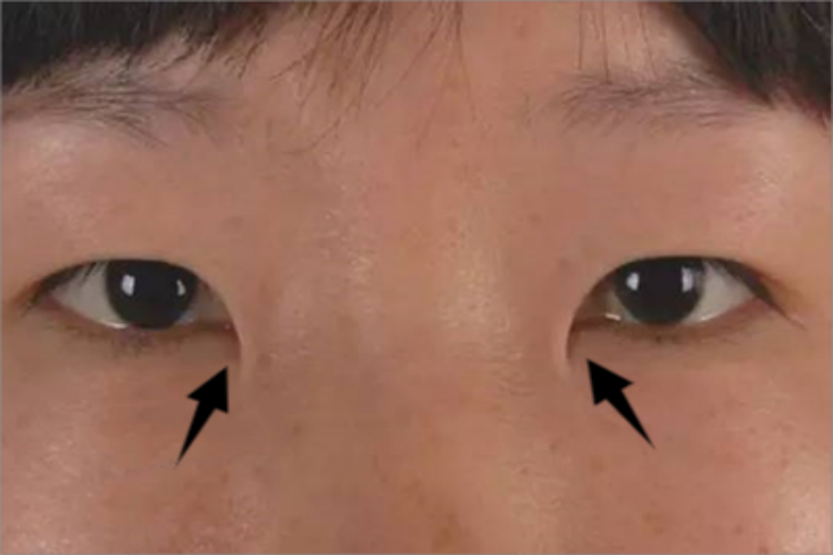 内眦赘皮症状图