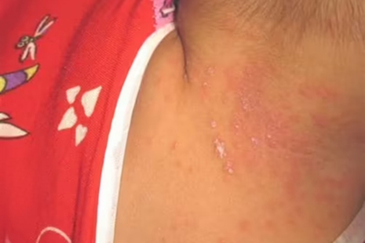 新生儿红斑后脖子有小红疙瘩图 新生儿红斑后脖子有小红疙瘩图