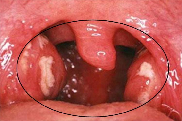 患者自觉咽干咽痒,咽喉疼痛,吞咽困难,可伴有发热等症状