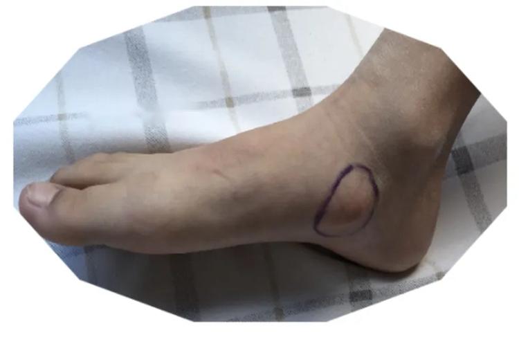 儿童足副舟骨突出图 儿童足副舟骨突出图