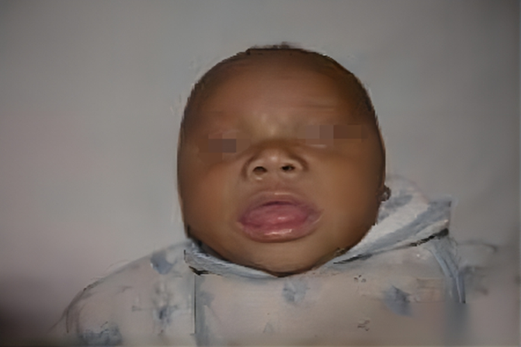 先天性甲状腺功能减低症图