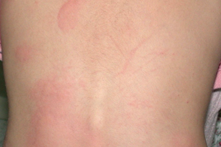 荨麻疹性血管炎背部红斑图