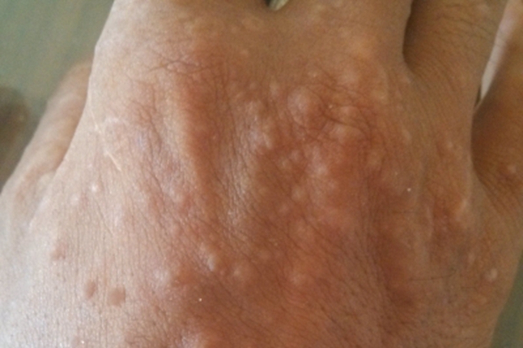 结节病手背症状图 结节病手背症状图