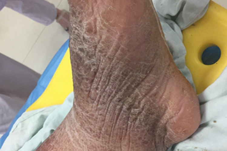 黏液性水肿皮肤增厚图 黏液性水肿皮肤增厚图