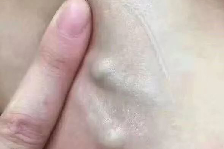 乳腺癌腋下淋巴结肿大图