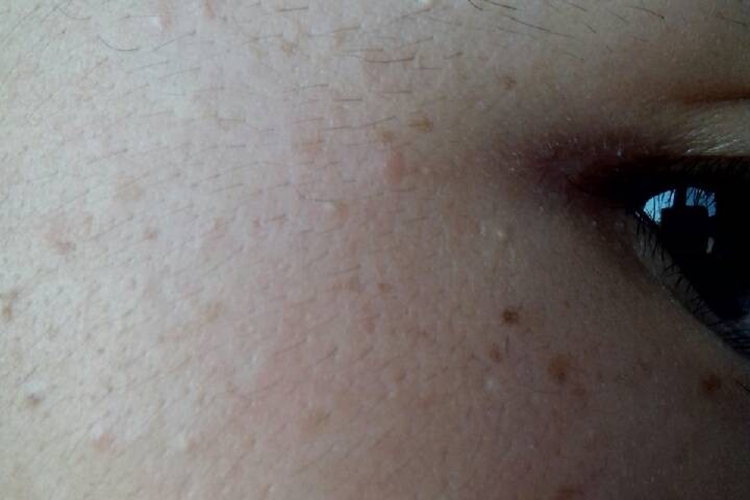 皮脂腺异位症图