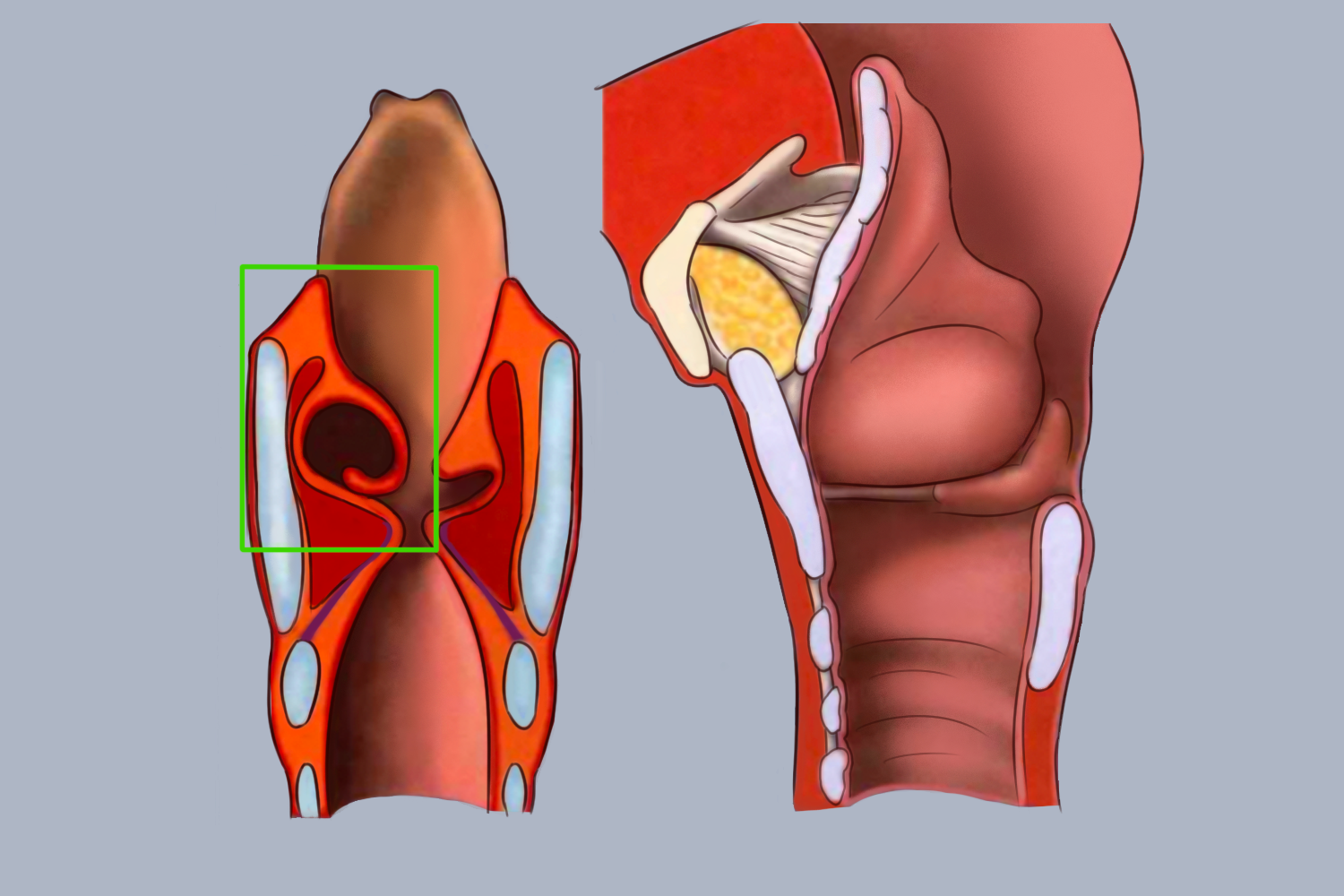 喉内型喉气囊肿图