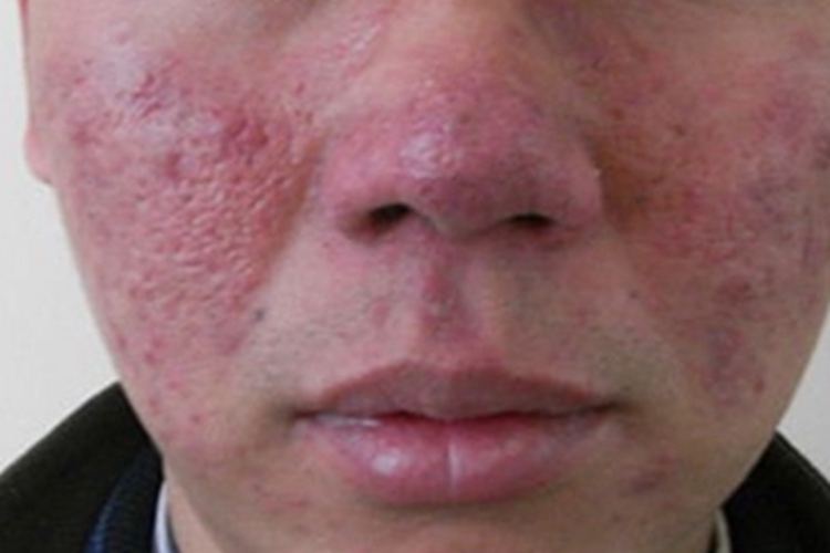 丘疹脓疱型酒糟鼻面部症状图 丘疹脓疱型酒糟鼻面部症状图