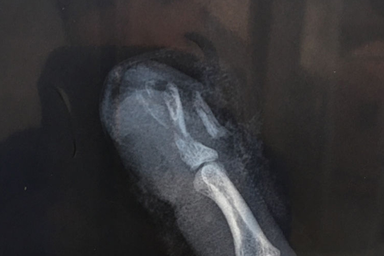 手指夹伤骨折影像图 手指夹伤骨折影像图