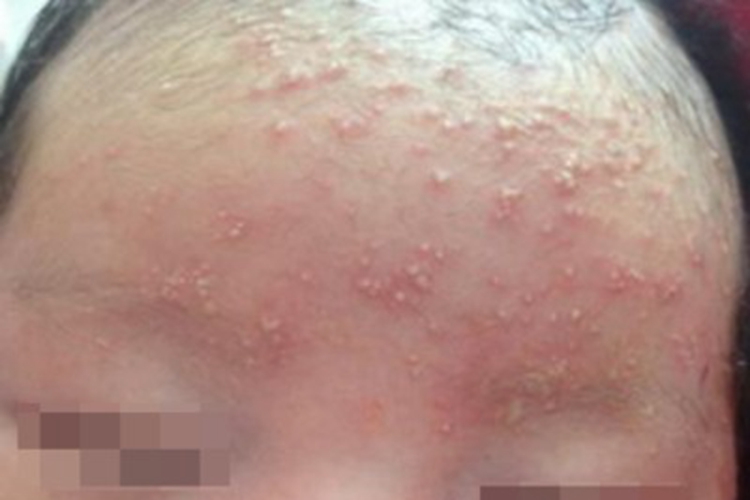 红痱额头丘疱疹图