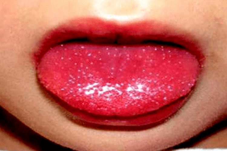 普通型猩红热舌头症状图