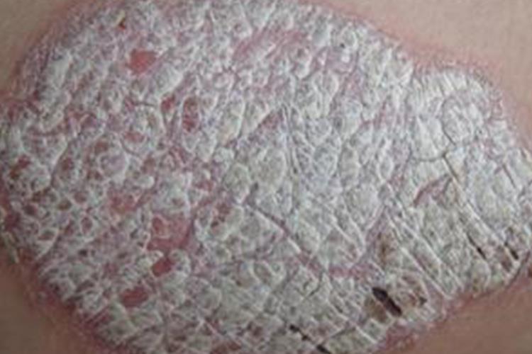 寻常型银屑病图