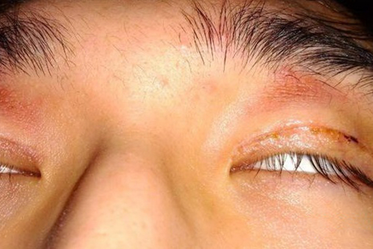 轻度眼睑闭合不全图 轻度眼睑闭合不全图