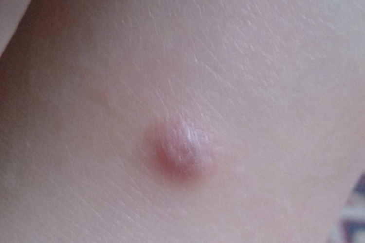 透明细胞汗腺瘤胳膊疙瘩图