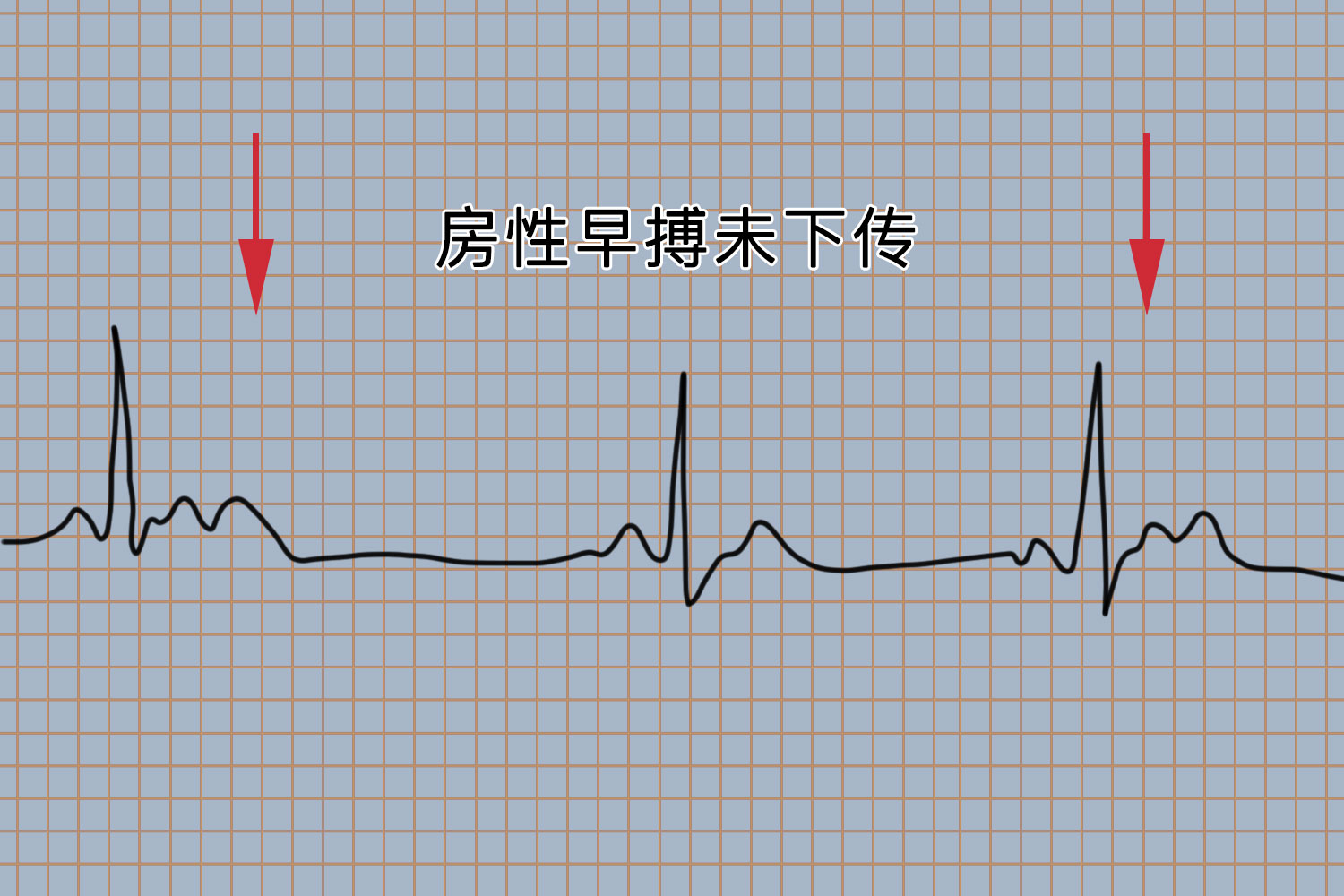 房性期前收缩心电图图