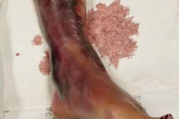 坏死性筋膜炎紫斑图