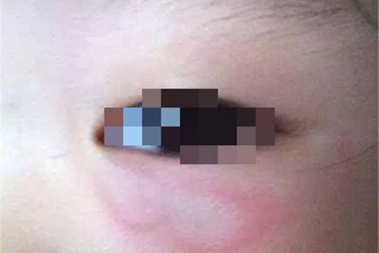 虫咬皮炎眼睑大疙瘩图 虫咬皮炎眼睑大疙瘩图