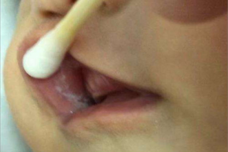 鹅口疮上嘴唇大片白斑图 鹅口疮上嘴唇大片白斑图