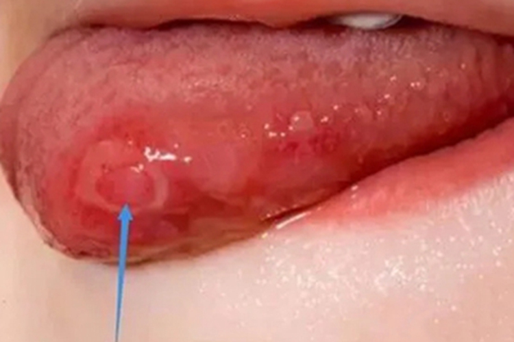 一期口腔梅毒舌尖症状图