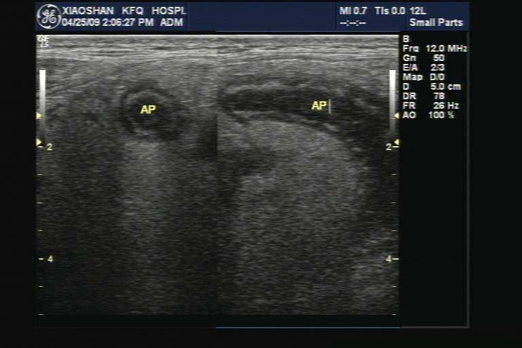 阑尾炎超声声像“靶环”征图 阑尾炎超声声像“靶环”征图