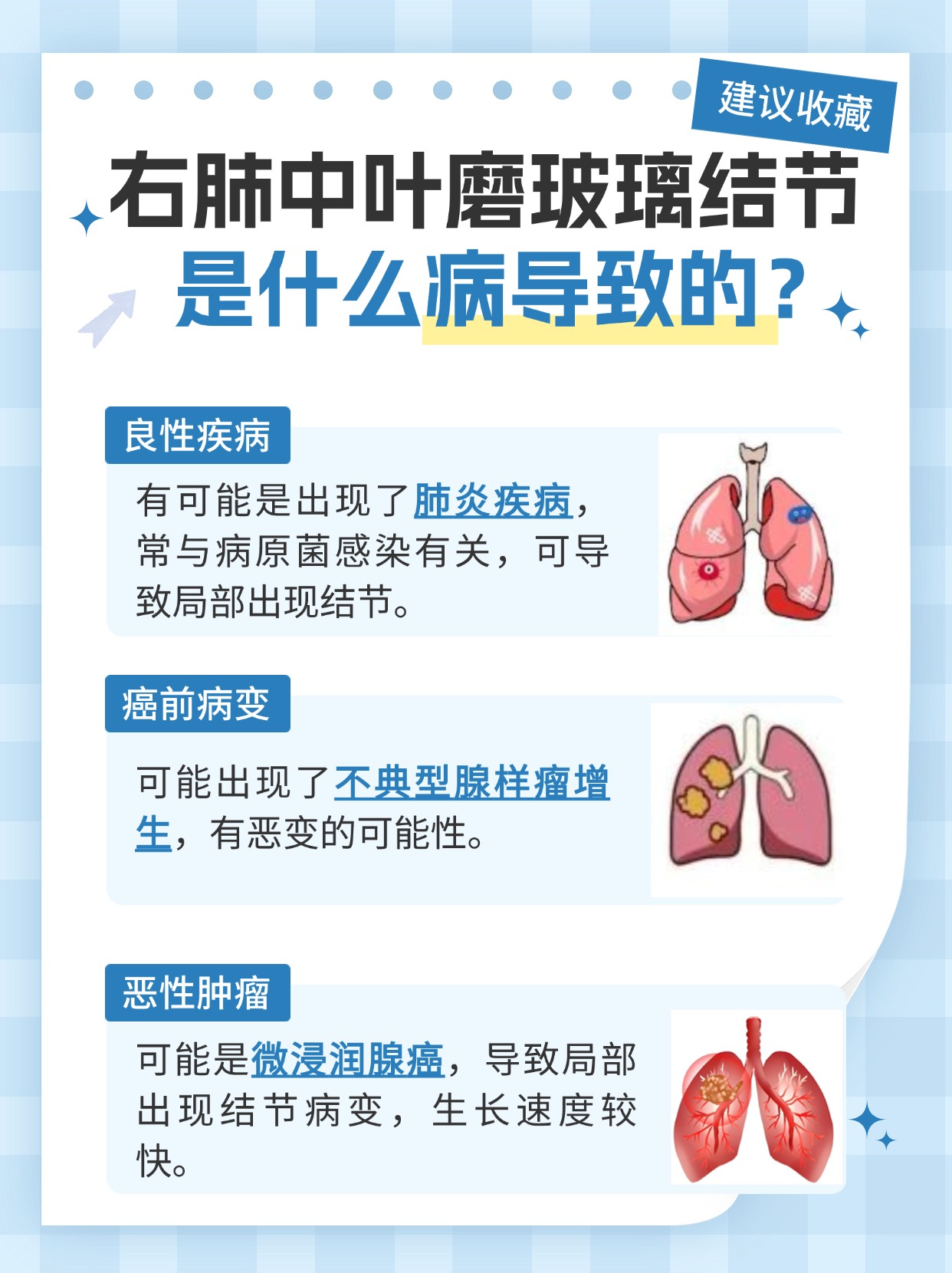 右肺中叶磨玻璃结节是什么病？一篇文章带你了解