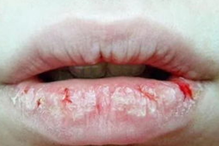 维生素A过多症嘴唇脱皮图