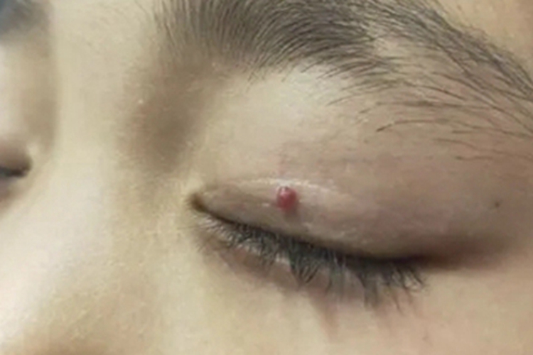 杆菌性血管瘤病症状图 杆菌性血管瘤病症状图