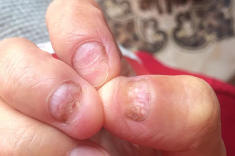 甲真菌病手指甲变薄图