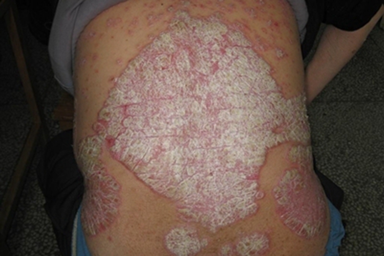 苔藓样型副银屑病背部症状图