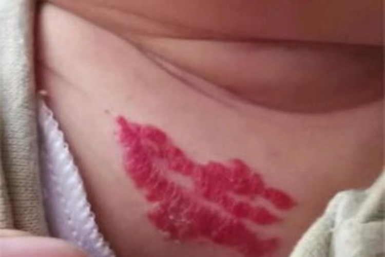 丛状血管瘤胸部小红疙瘩图