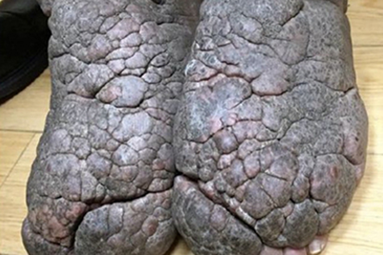 胫前黏液性水肿脚背症状图