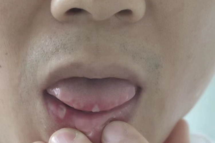 复发性阿弗他溃疡白点图 复发性阿弗他溃疡白点图