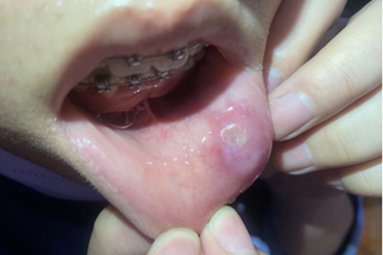 重型阿弗他溃疡唇内侧溃疡图