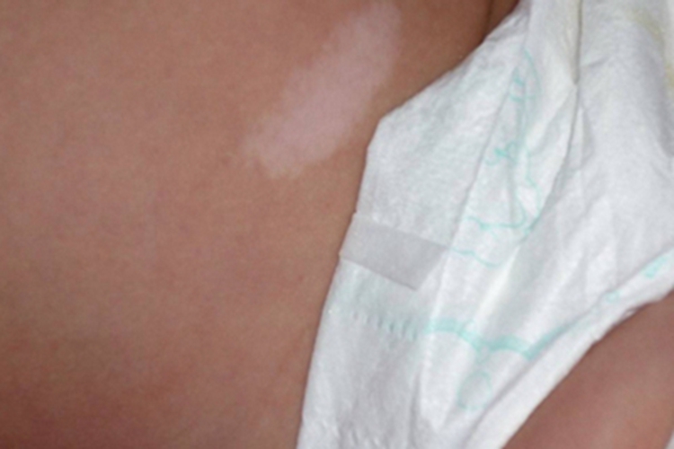 花斑糠疹腹部有条状白斑图