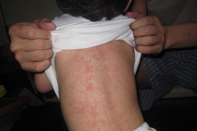 婴儿急疹后背图