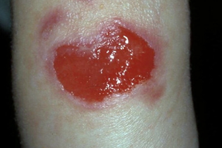 大疱性表皮松解症胳膊症状图