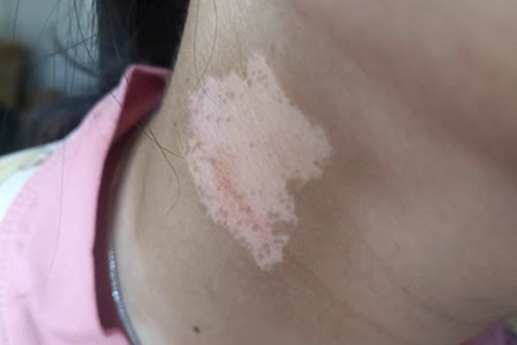 稳定期节段型白癜风颈部有白斑图