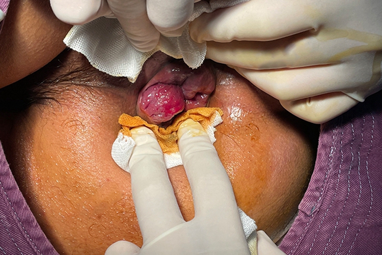 Ⅱ度内痔痔核脱出肉球图