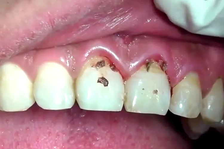 牙结石指数1度图 牙结石指数1度图