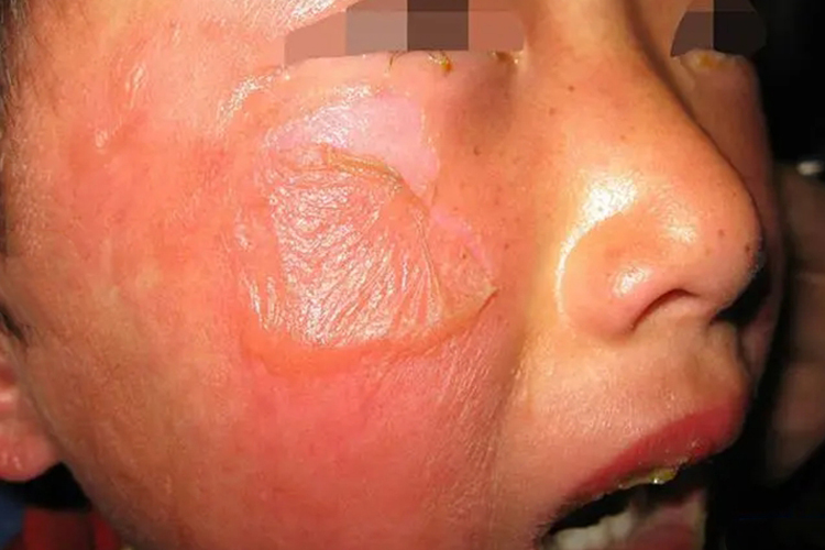 皮肤易剥离图 皮肤易剥离图