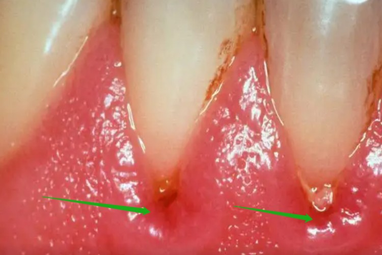 牙龈炎图 牙龈炎图
